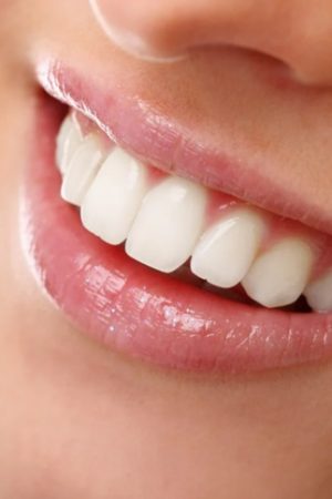 Teeth Whitening